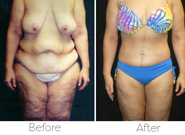 Body Contouring: Effects, Weight Loss, and Goal of Surgery
